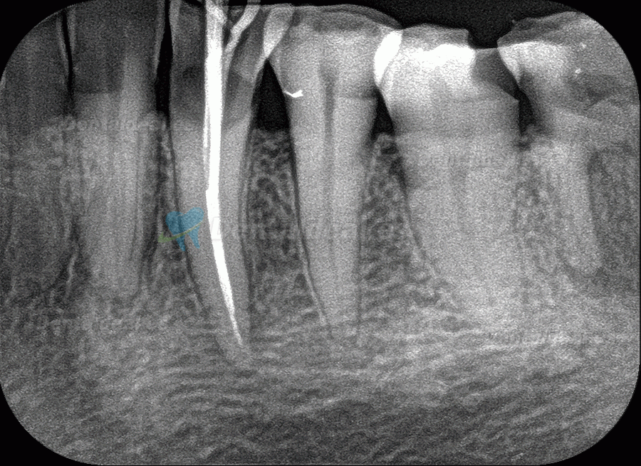 Fussen F200 Dental Phosphor Plate Scanner PSP X ray Scanner